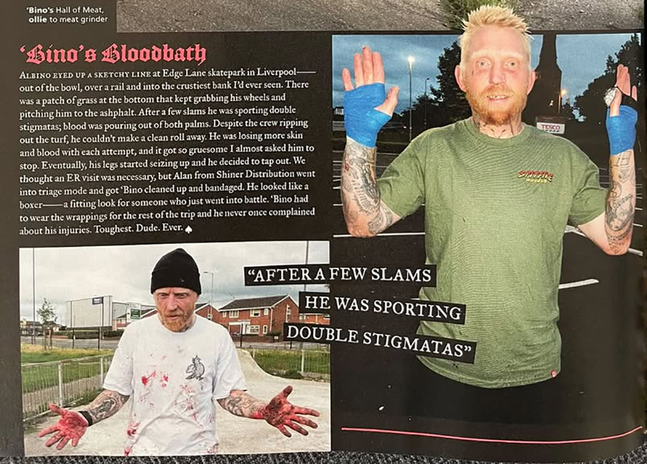 Bino's injuries on the Turbo Island tour were patched up by Alan